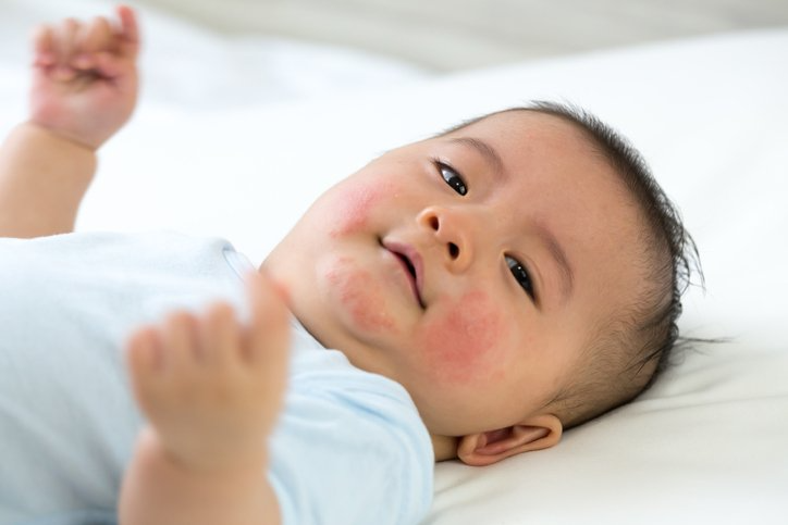 What causes baby acne?