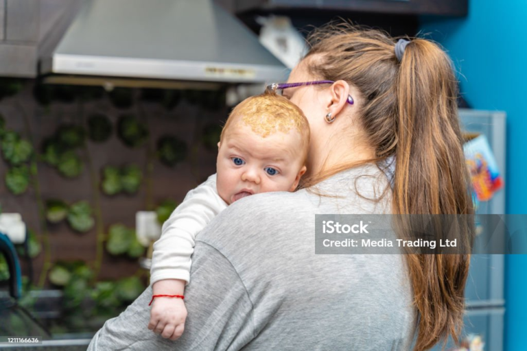 Cradle cap (infantile seborrheic dermatitis)