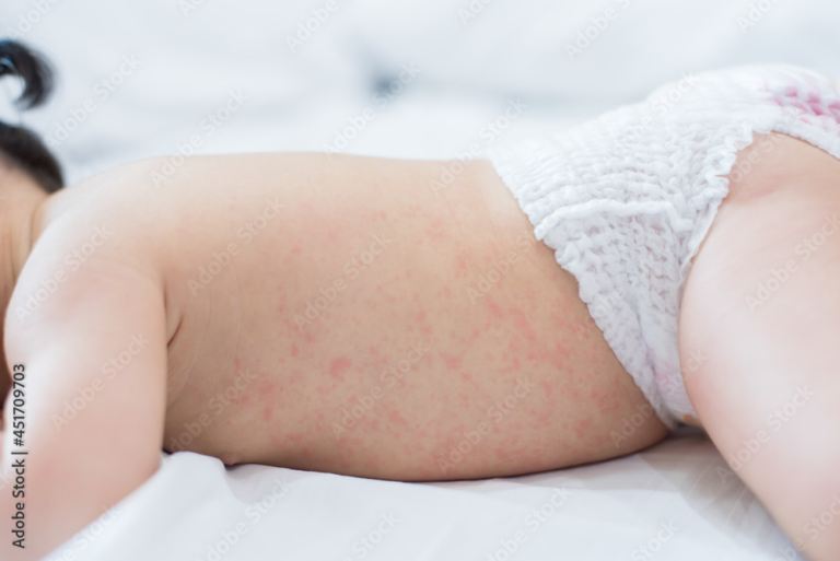 Baby Heat Rash: Understanding, Treating, and Preventing Prickly Heat