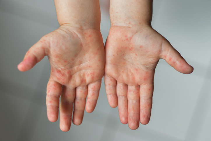 Hand, Foot, and Mouth Disease (HFM): Understanding, Symptoms, and Prevention