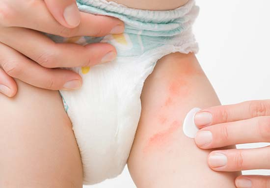 How to treat diaper rash?