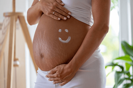 Stretch Marks During Pregnancy: Causes, Prevention, and Treatment