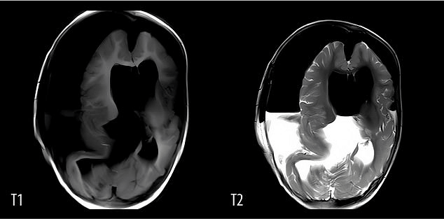 One-Year-Old Girl in China Found with Fetus in Her Skull: A Rare Medical Phenomenon