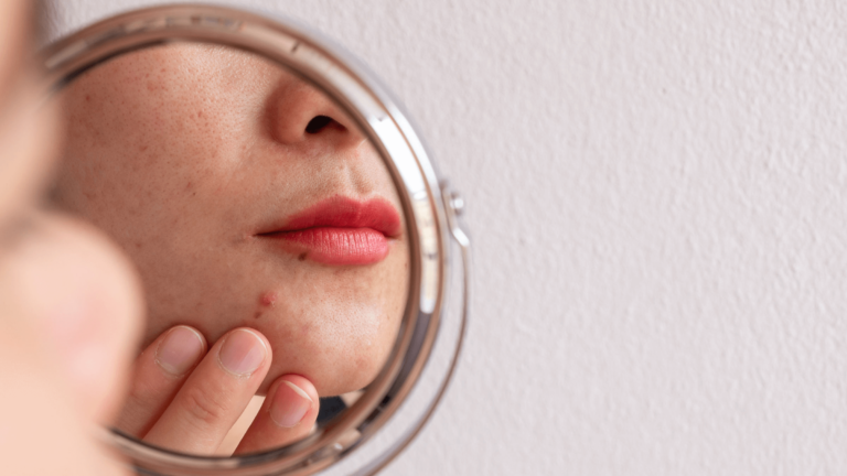 Safe Acne Treatments During Pregnancy: What You Need to Know