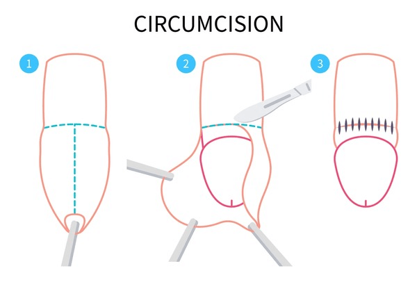 Circumcision in Baby Boys: A Complete Guide for Parents