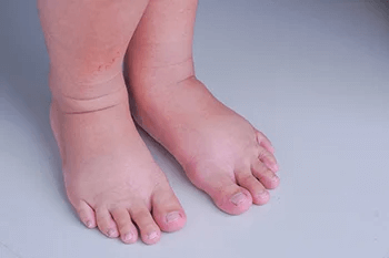 Complete Guide to Managing Swollen Feet, Ankles, and Hands During Pregnancy